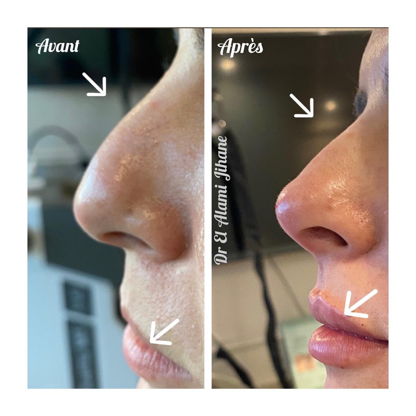 Résultat traitement peau Marrakech 2