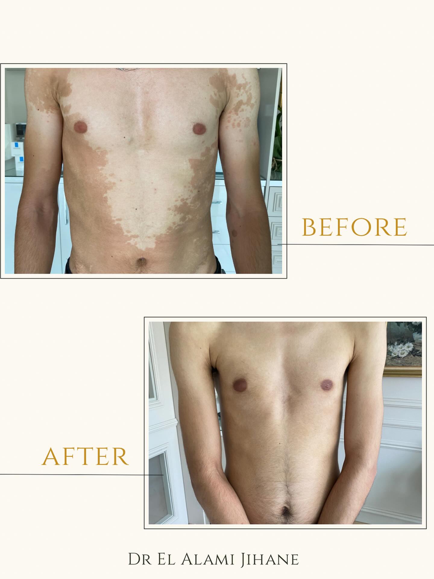 Résultat traitement peau Marrakech 4